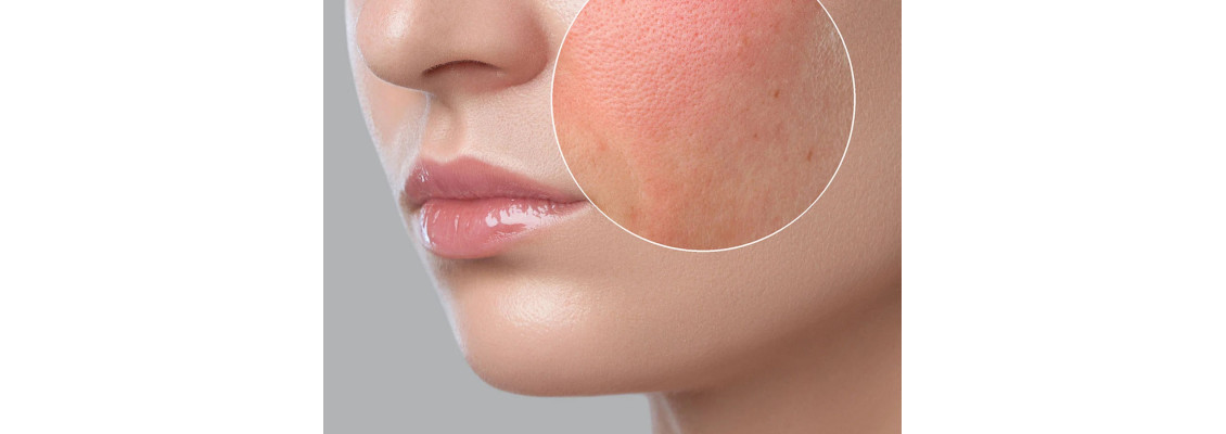 Conquering Dry Skin: A Lady's Guide to Hydration