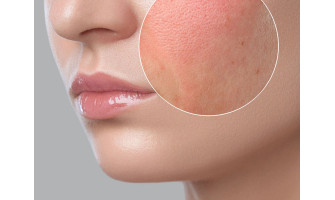 Conquering Dry Skin: A Lady's Guide to Hydration
