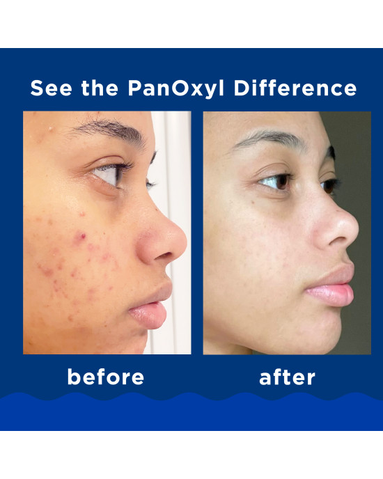PanOxyl Acne Foaming Wash Benzoyl Peroxide 10% Maximum Strength